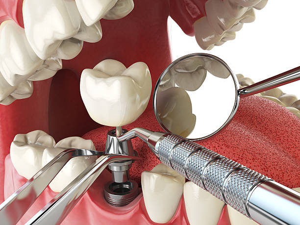 Best Emergency Treatment for Dental Infections or Abscesses in Cutten, CA